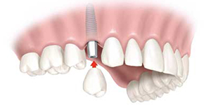 Dental Implants Hollywood FL