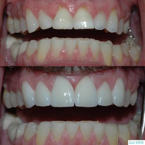 Full Coverage Crowns - Before & After