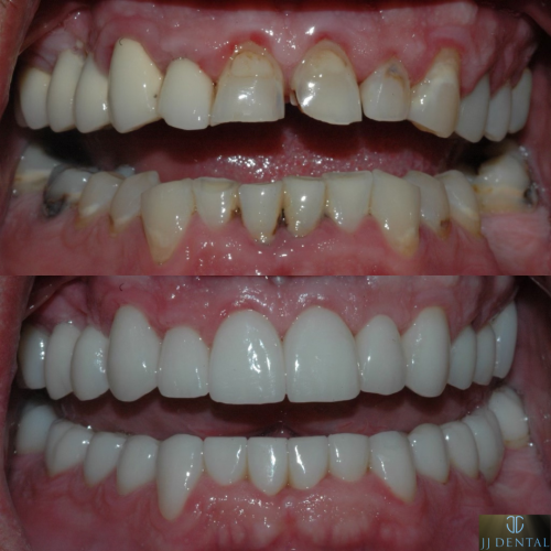 Total Mouth Rehabilitation Before & After