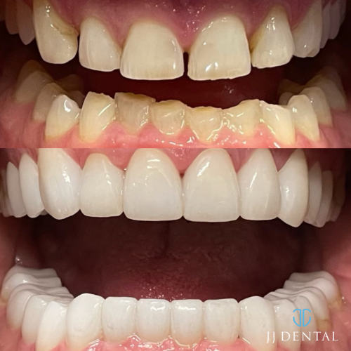 b&a Dr Resh - full mouth 30 crowns 7.19